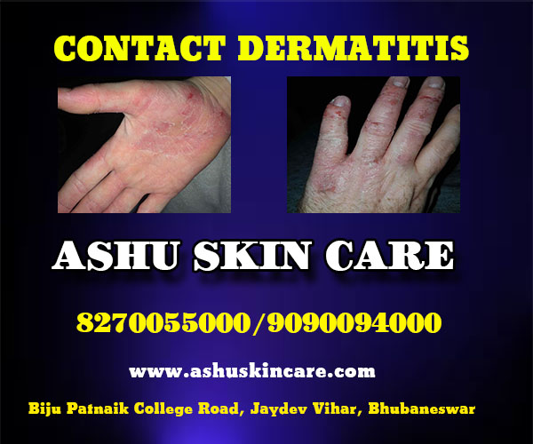 best dermatitis treatment clinic in bhubaneswar near hitech hospital